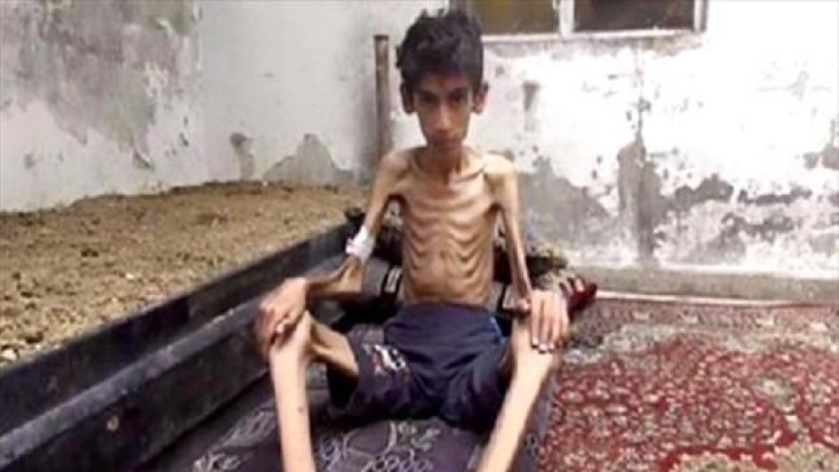 Desnutrición 8Manifestantes con la imagen de un niño, supuestamente de Madaya, en una protesta en Beirut. A la derecha, una foto distribuida por el Consejo Revolucionario de Madaya.