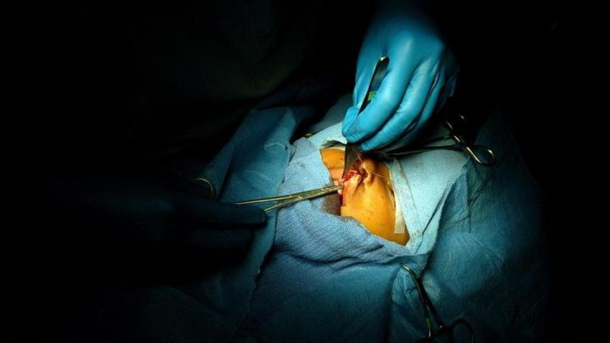 Imagen de una operación de labio leporino. ORLANDO BARRIA