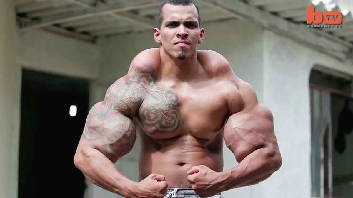 Romario Dos Santos puso en riesgo su vida al inyectarse durante años Synthol y alcohol en sus bíceps