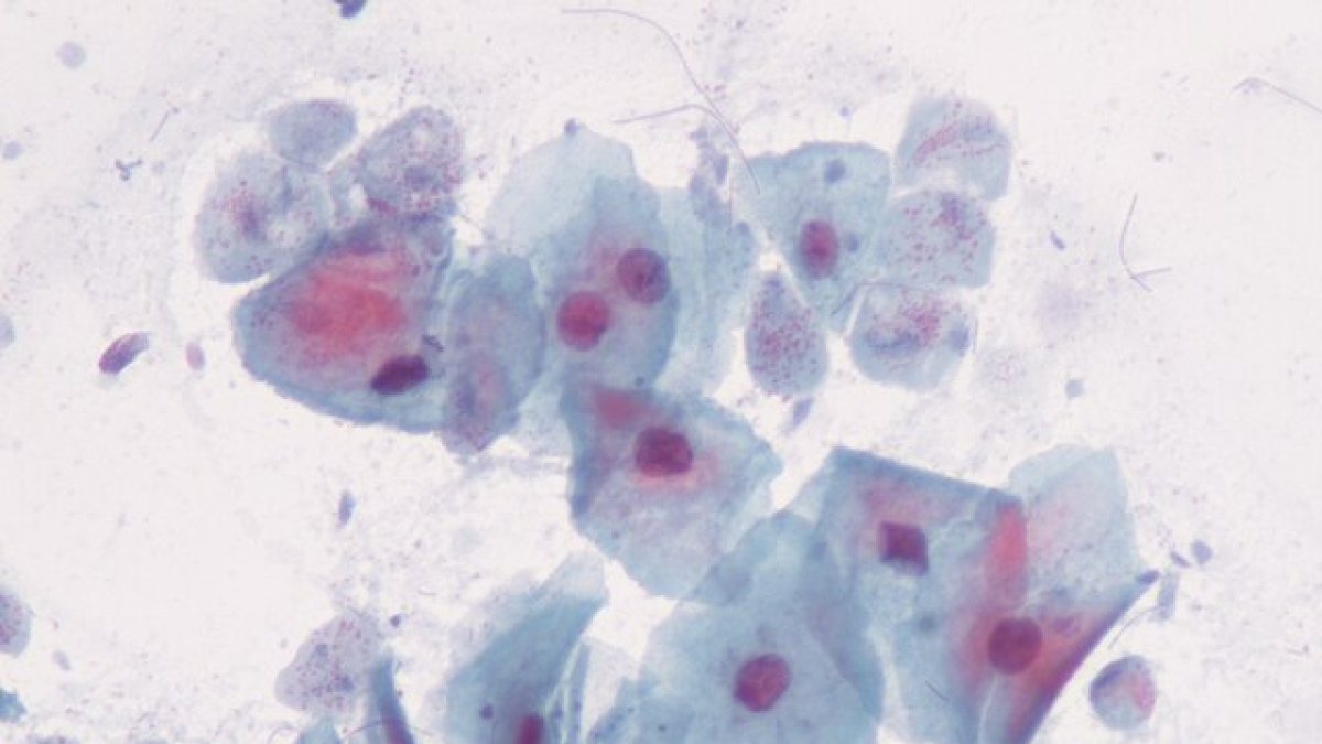 La gonorrea es una enfermedad de transmisión sexual.