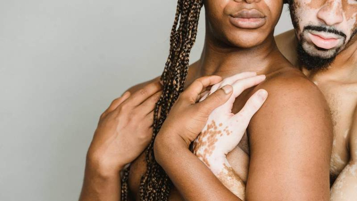 Manchas en la piel provocadas por la psoriasis.  ARMIN RIMOLDI