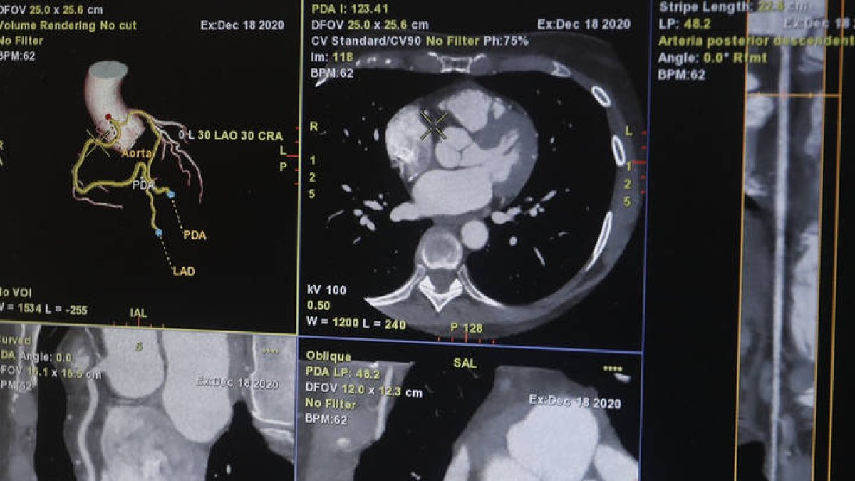 Uno de cada 4 pacientes con insuficiencia cardiaca en León fallece o reingresa en 1 año