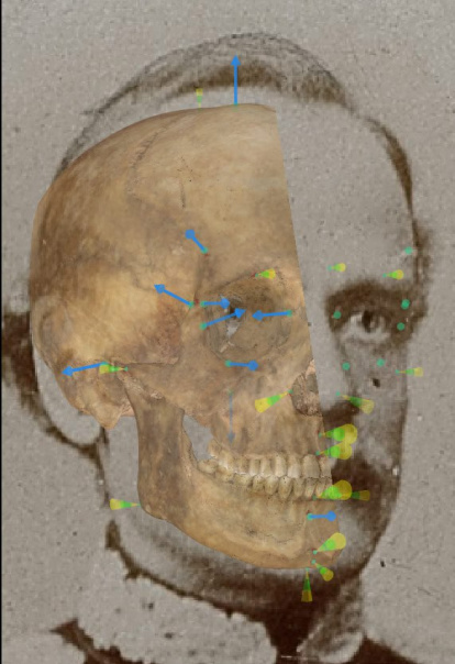 Superposición craneofacial de Zygmut Sierakowski.