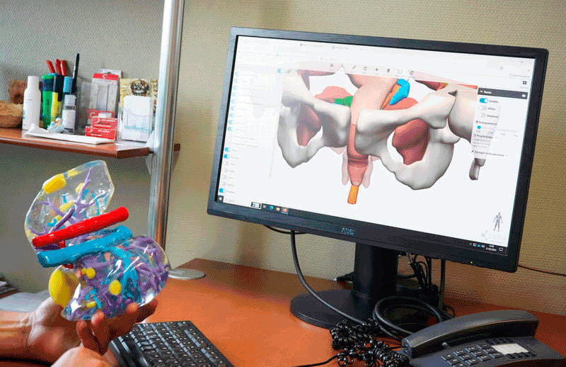 La tecnología 3D revoluciona los quirófanos. J. NOTARIO